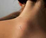 Acupuncture. neck